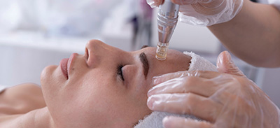 a woman partaking in a micro needling session on her forehead